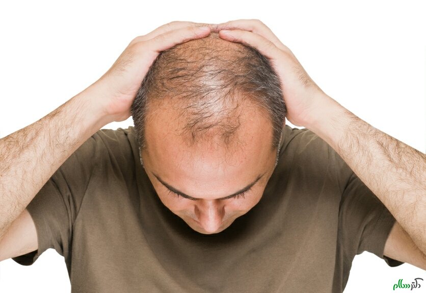 راه جلوگیری از ریزش موی شدید

