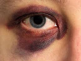 درمان کبودی چشم در اثر ضربه
