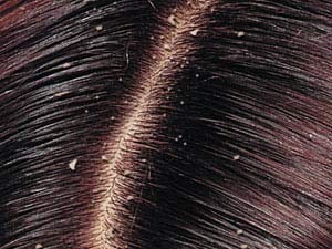 راههای جلوگیری از شوره موی سر
