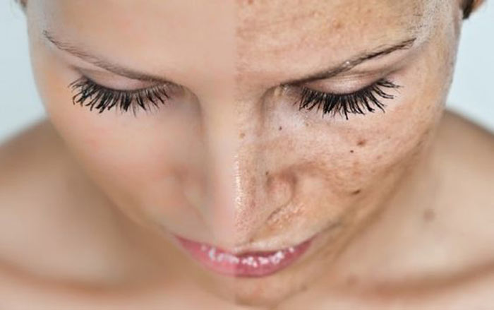 راههای جلوگیری از لکه های صورت در دوران باردا