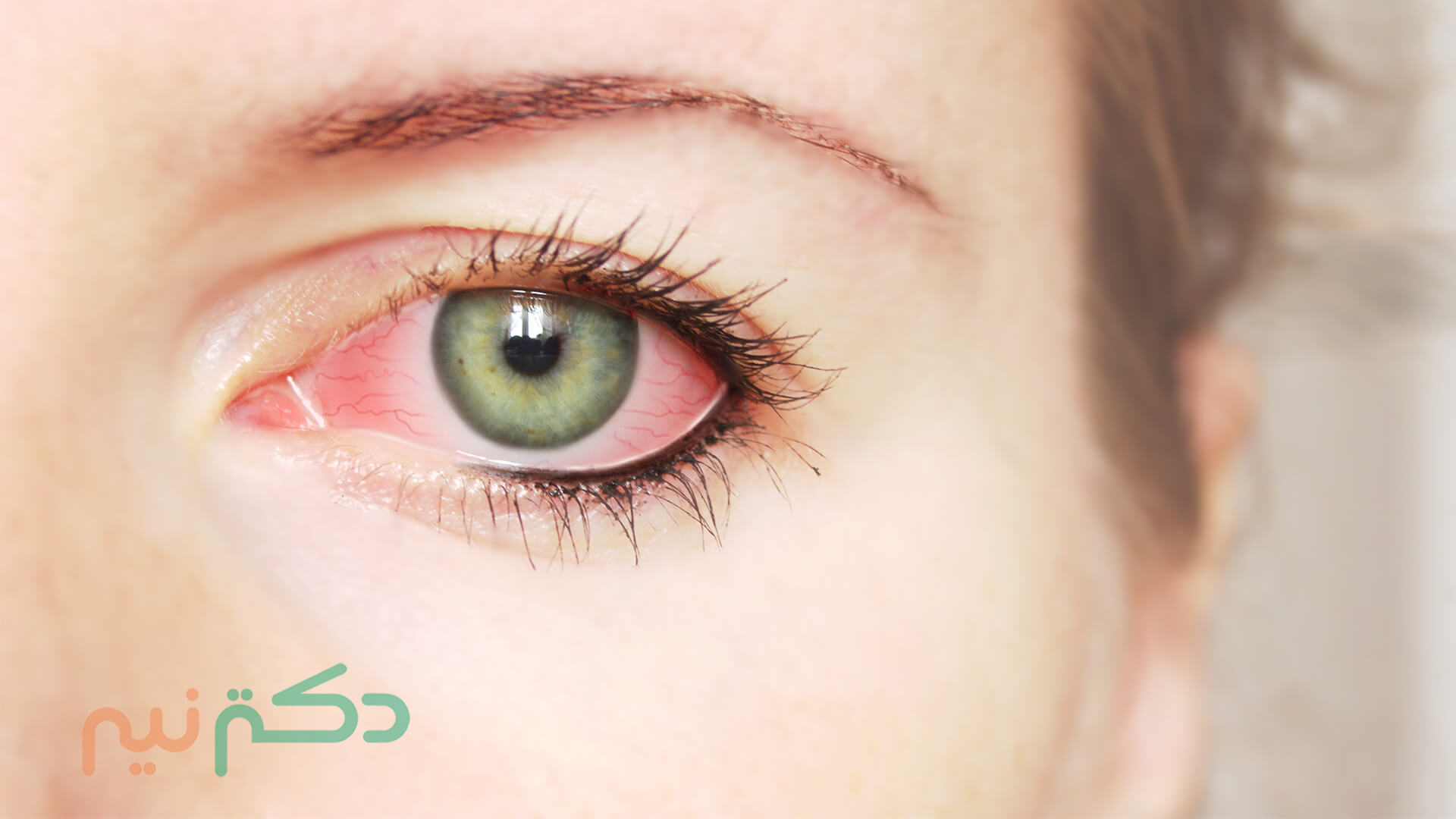 راههاي درمان عفونت چشم

