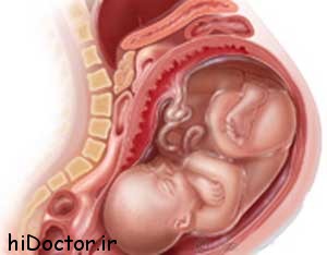برای جلوگیری از یبوست در بارداری چه باید کرد
