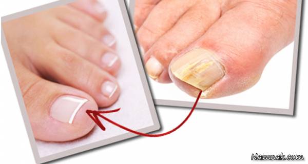 درمان عفونت انگشت پا با پیاز
