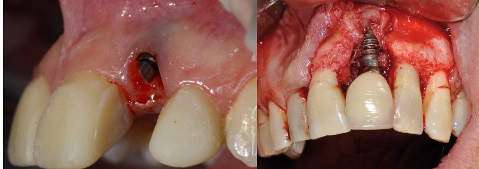 عفونت دندان ایمپلنت شده
