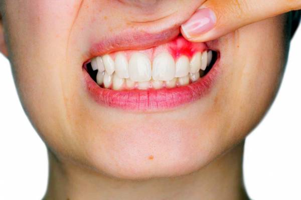 عفونت دندان به انگلیسی
