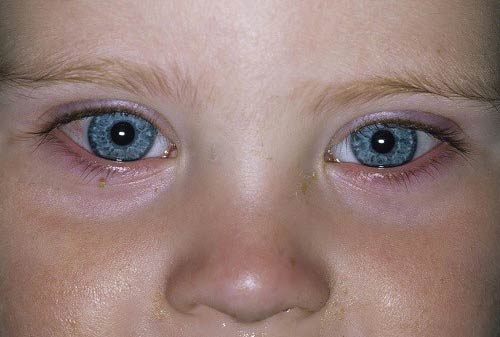 عفونت چشم کودک یک ساله
