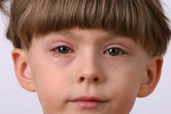 عفونت چشم در کودکان چند روز طول میکشد
