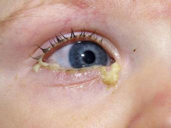 عفونت چشم نوزاد سه ماهه
