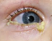 عفونت چشم کودک یک ساله
