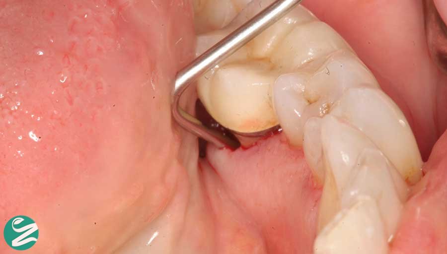 درمان عفونت دندان کشیده شده
