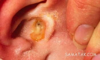 عفونت گوش خارجی در بزرگسالان
