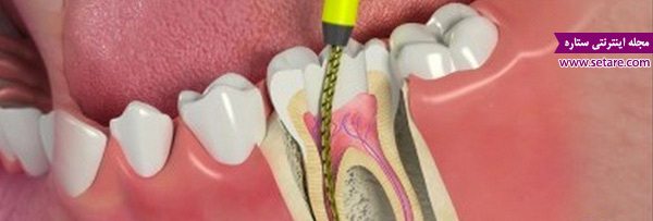 عفونت دندان عصب کشی شده
