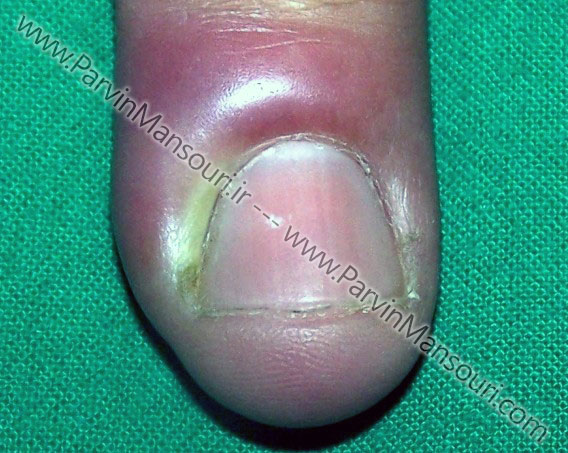درمان عفونت گوشه ناخن دست
