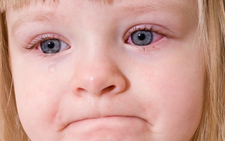 علائم عفونت چشم در کودکان
