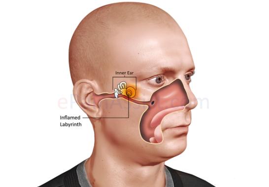 عفونت گوش داخلی و سرگیجه
