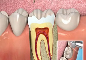 علت عفونت دندان پر شده
