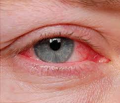 عفونت چشم در کودکان چند روز طول میکشد
