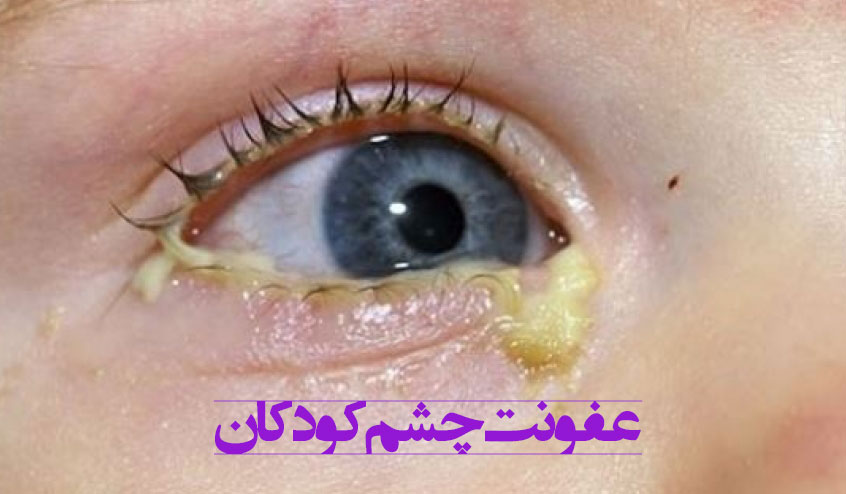 عفونت چشم کودکان
