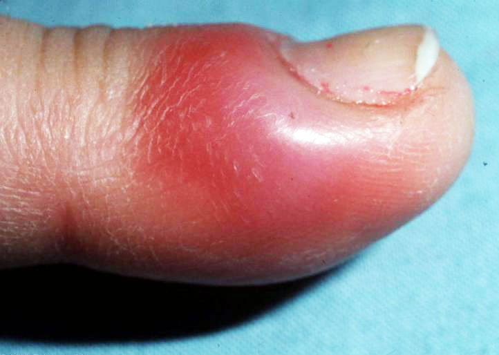 درمان عفونت گوشه ناخن دست
