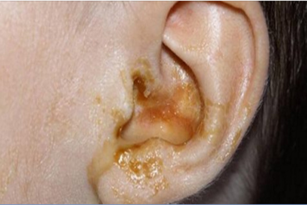 عفونت گوش نوزاد سه ماهه
