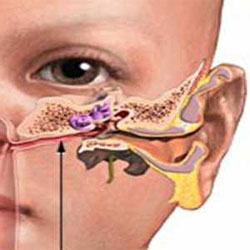 عفونت گوش میانی درمان گیاهی
