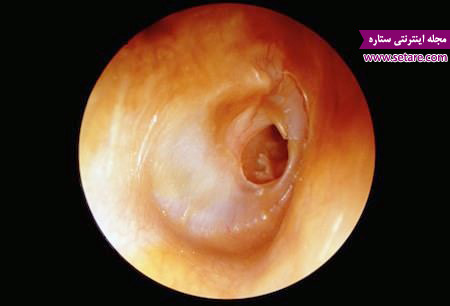 داروی عفونت گوش میانی چیست
