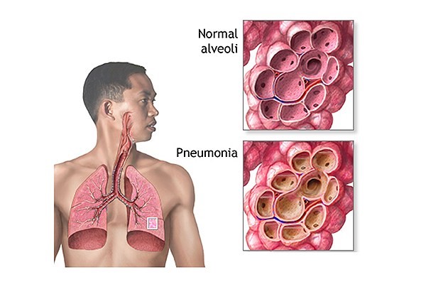 علت عفونت ریه ها چیست
