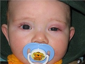 درمان عفونت چشم کودک پنج ماهه

