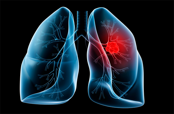 عفونت ریه چه درمانی دارد
