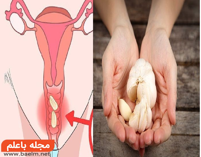 بهترین درمان خانگی عفونت واژن در بارداری
