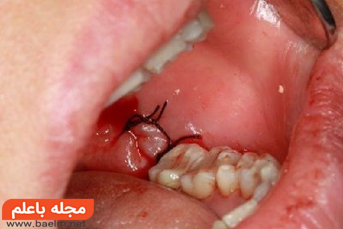 جلوگیری از عفونت بعد از جراحی دندان عقل
