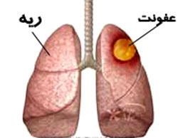 عفونت ریه برای چیست

