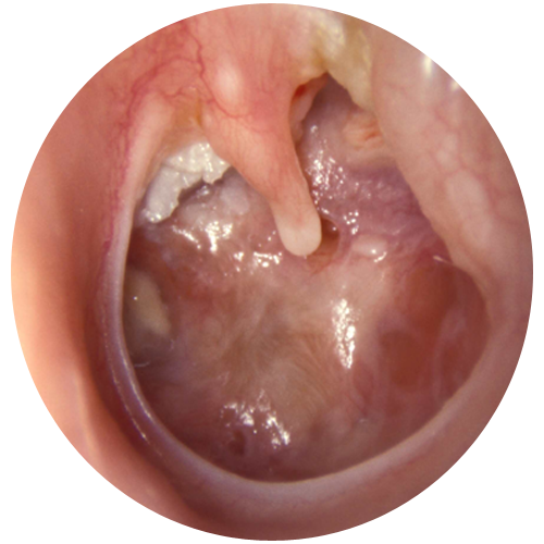 التهاب گوش میانی چیست
