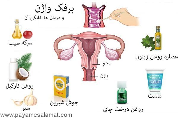 درمان خانگی عفونت پنیری واژن در بارداری
