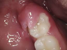 التهاب لثه اطراف دندان عقل
