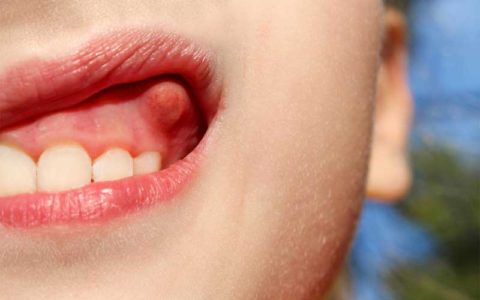 تاثیر عفونت دندان بر سردرد
