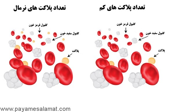 كمبود پلاكت خون در بارداري
