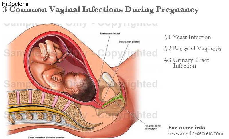 عفونت شدید رحم در بارداری
