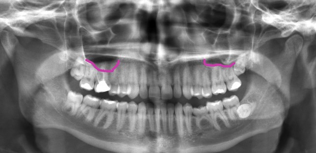 عفونت سینوسی و دندان درد
