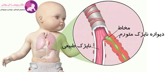 درمان عفونت ریه در نوزادان نارس
