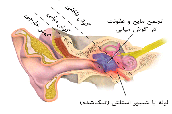 سرگیجه و التهاب گوش میانی
