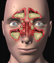 درمان عفونت سینوس های صورت
