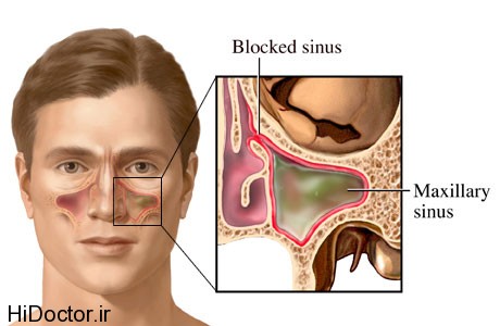 علایم عفونت سینوسهای صورت
