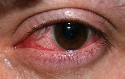 سرماخوردگی و عفونت چشم
