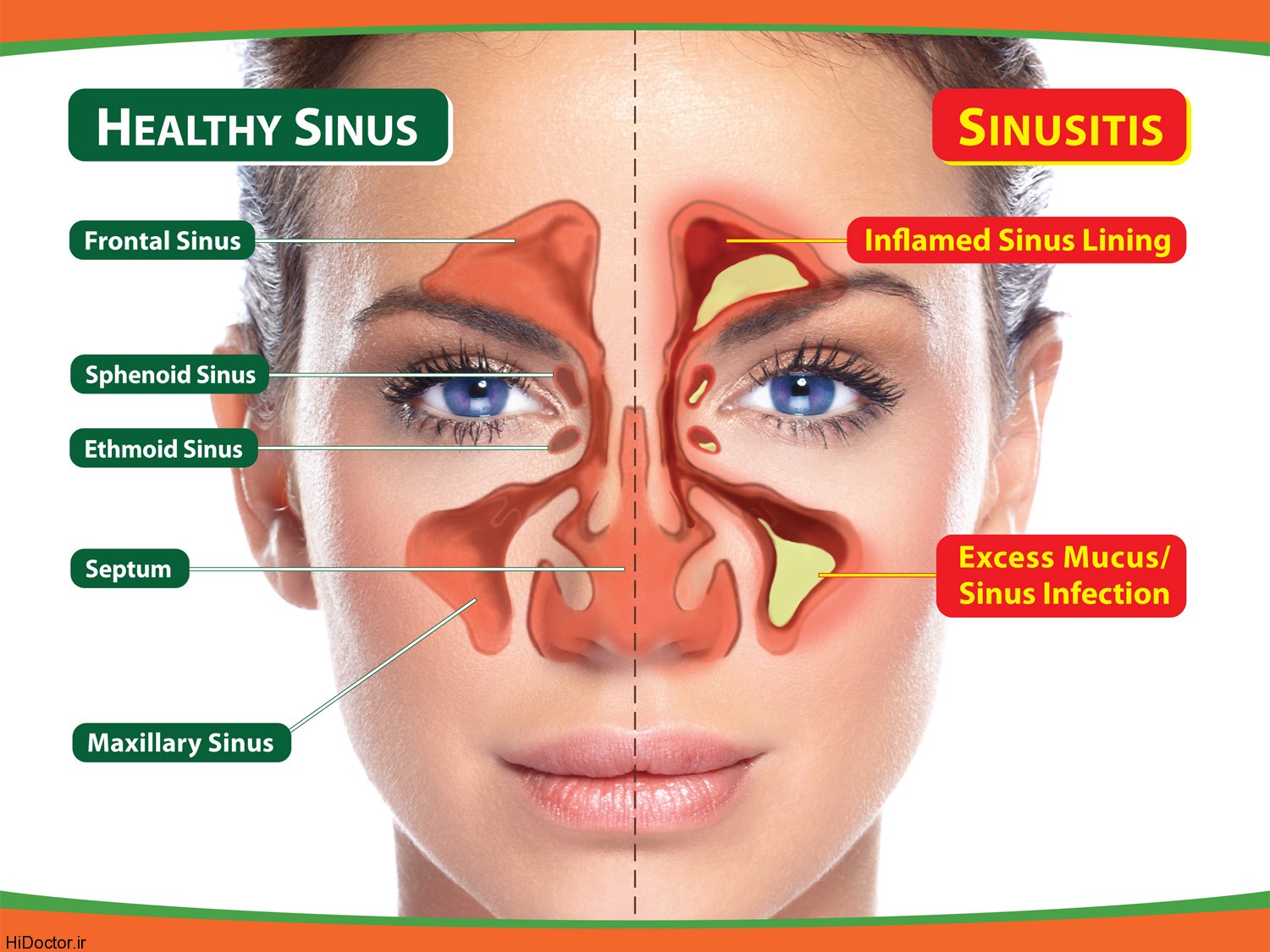 درمان عفونت سینوس های صورت
