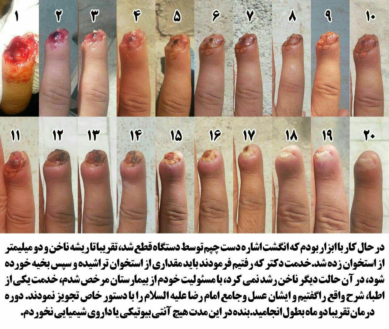 علت زخم نوک انگشتان دست
