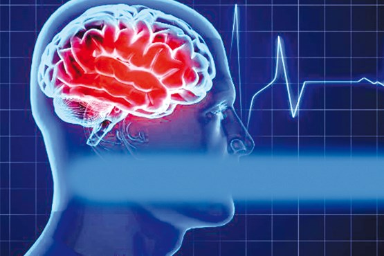 عوامل ابتلا به سکته مغزی
