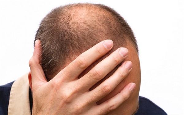کمبود کدام ویتامین در بدن باعث ریزش موی سر می
