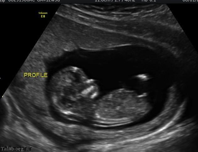 چگونه در ماه دوم بارداری جنسیت جنین را تشخیص 