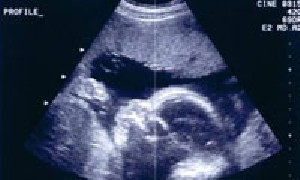 تعیین جنسیت جنین در سه ماهه اول بارداری
